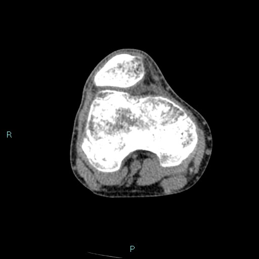 File:Chronic osteomyelitis (with Brodie abscess) (Radiopaedia 76405-88111 A 141).jpg