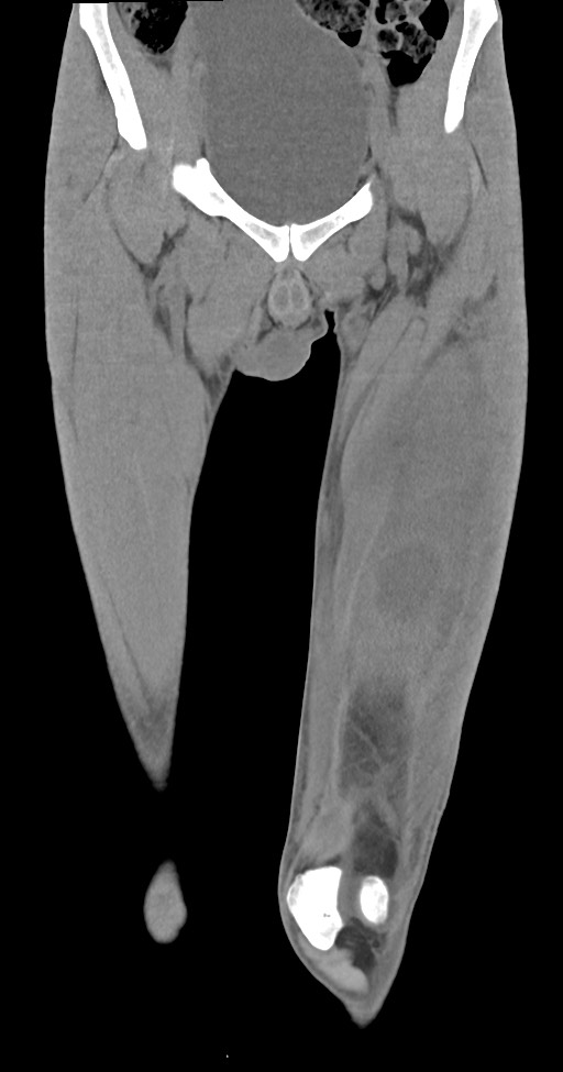Chronic osteomyelitis (with sequestrum) (Radiopaedia 74813-85822 E 14).jpg