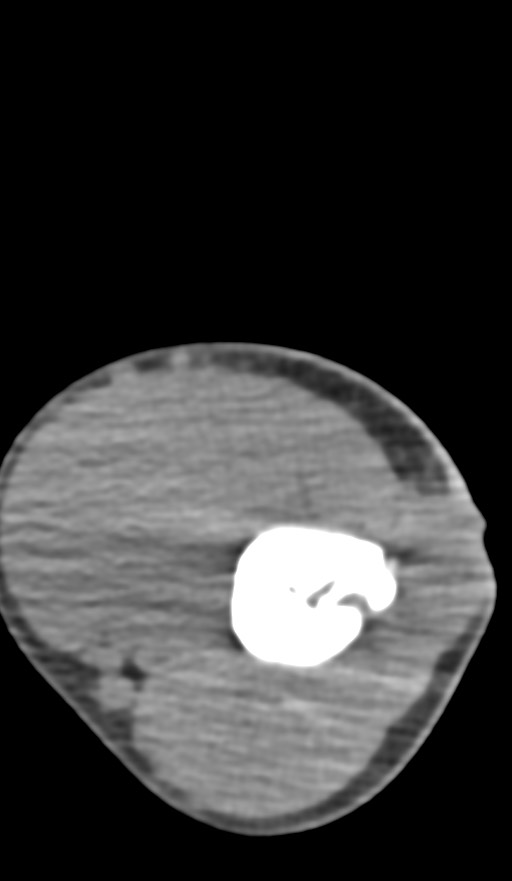 Chronic osteomyelitis of the distal humerus (Radiopaedia 78351-90971 Axial non-contrast 62).jpg