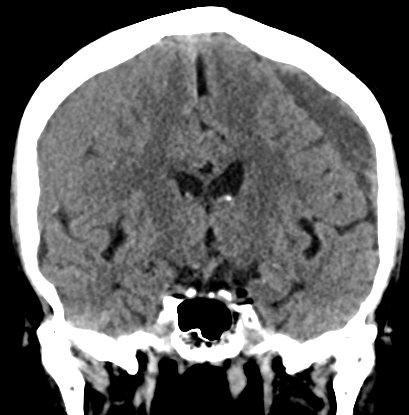 Chronic subdural hematomas (Radiopaedia 66577-75885 Coronal non-contrast 30).jpg
