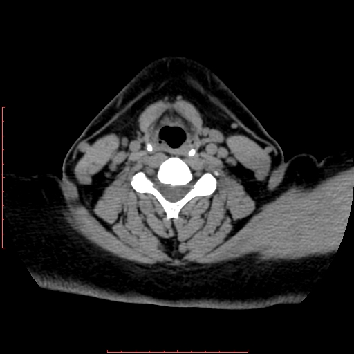Chronic submandibular sialolithiasis (Radiopaedia 69817-79814 Axial non-contrast 159).jpg