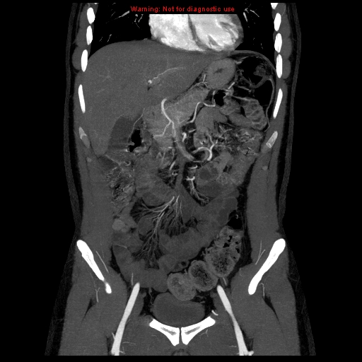 File:Circumaortic left renal vein (Radiopaedia 9069-9792 B 7).jpg
