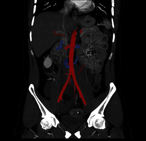 File:Circumaortic left renal vein (Radiopaedia 9069-9792 C 4).jpg