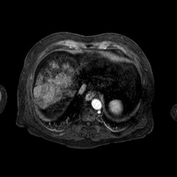 Cirrhosis and hepatocellular carcinoma in the setting of hemochromatosis (Radiopaedia 75394-86594 Axial T1 C+ fat sat 153).jpg