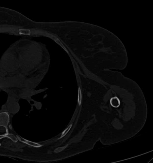 Clear cell chondrosarcoma - humerus (Radiopaedia 63104-71612 Axial bone window 86).jpg