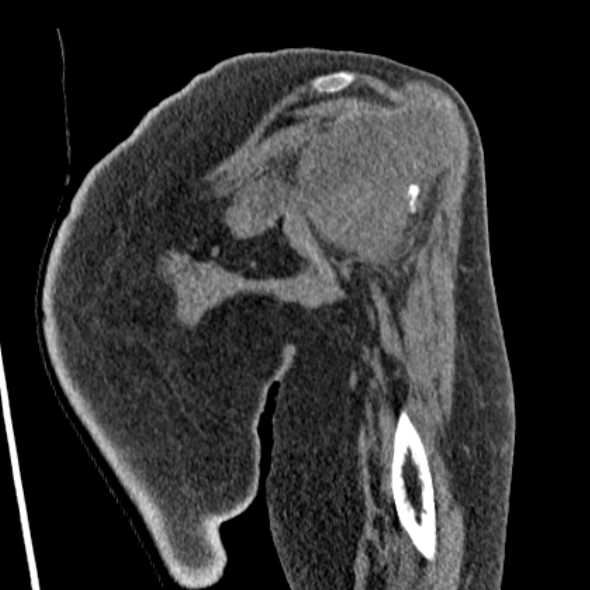 Clear cell chondrosarcoma - humerus (Radiopaedia 63104-71612 Coronal non-contrast 15).jpg