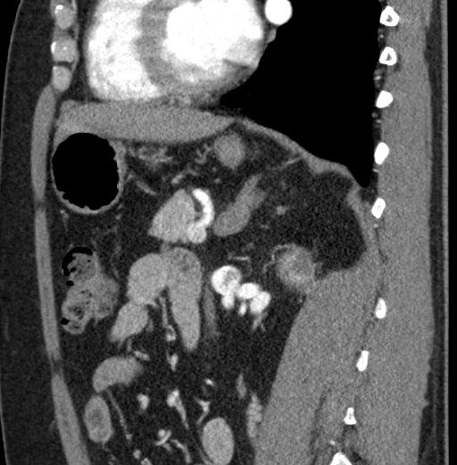 File:Clear cell renal cell carcinoma (Radiopaedia 61449-69393 D 42).jpg