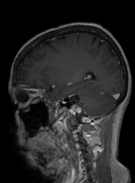 File:Clival meningioma (Radiopaedia 53278-59248 Sagittal T1 C+ 207).jpg