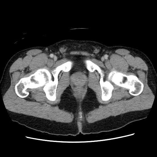 File:Closed-loop small bowel obstruction (Radiopaedia 73713-84509 A 170).jpg