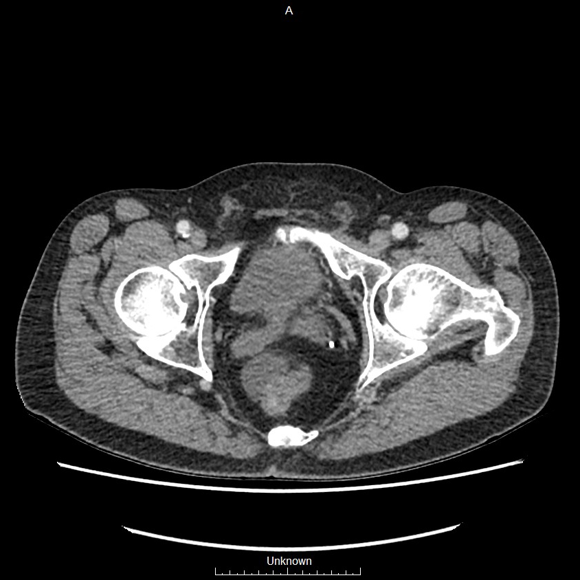 Closed loop bowel obstruction and ischemia (Radiopaedia 86959-103180 A 85).jpg