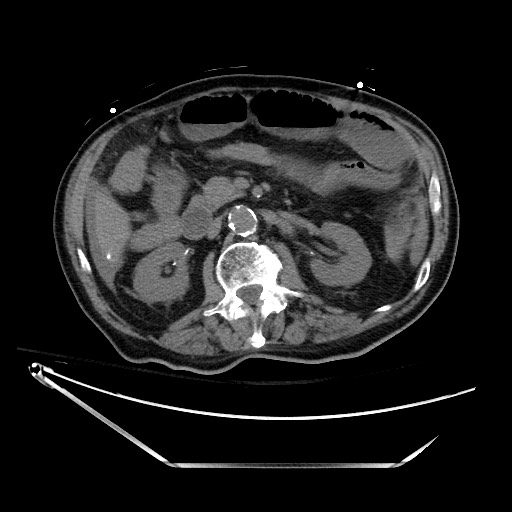 File:Closed loop obstruction due to adhesive band, resulting in small bowel ischemia and resection (Radiopaedia 83835-99023 Axial non-contrast 63).jpg