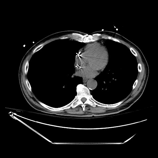 File:Closed loop obstruction due to adhesive band, resulting in small bowel ischemia and resection (Radiopaedia 83835-99023 Axial non-contrast 7).jpg
