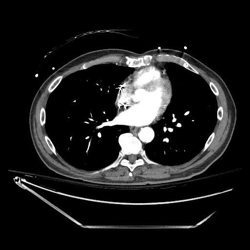 File:Closed loop obstruction due to adhesive band, resulting in small bowel ischemia and resection (Radiopaedia 83835-99023 B 3).jpg
