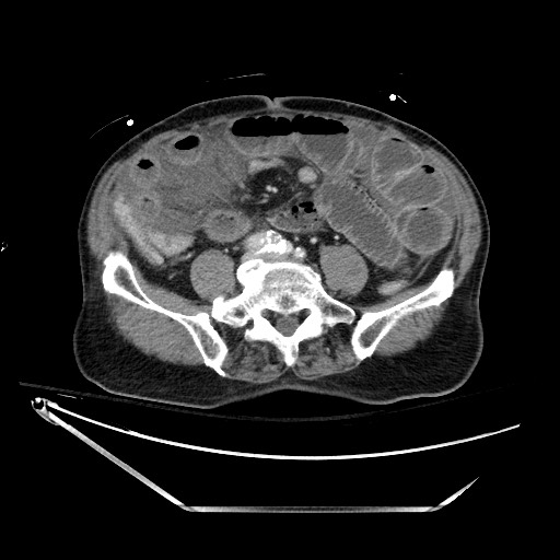 Closed loop obstruction due to adhesive band, resulting in small bowel ischemia and resection (Radiopaedia 83835-99023 D 100).jpg