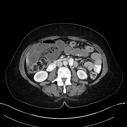 Closed loop small bowel obstruction - adhesions (Radiopaedia 59078-66369 A 60).jpg