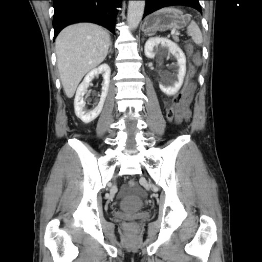 Closed loop small bowel obstruction - omental adhesion causing "internal hernia" (Radiopaedia 85129-100682 B 86).jpg