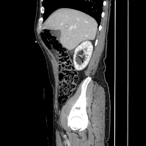 Closed loop small bowel obstruction - omental adhesion causing "internal hernia" (Radiopaedia 85129-100682 C 55).jpg
