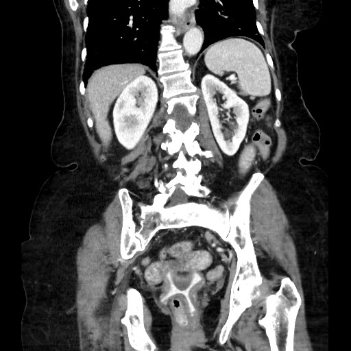 File:Closed loop small bowel obstruction due to adhesive band, with intramural hemorrhage and ischemia (Radiopaedia 83831-99017 C 132).jpg