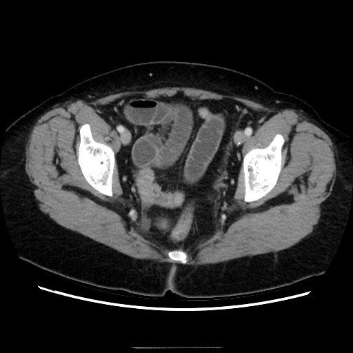 Closed loop small bowel obstruction due to adhesive bands - early and late images (Radiopaedia 83830-99015 A 149).jpg