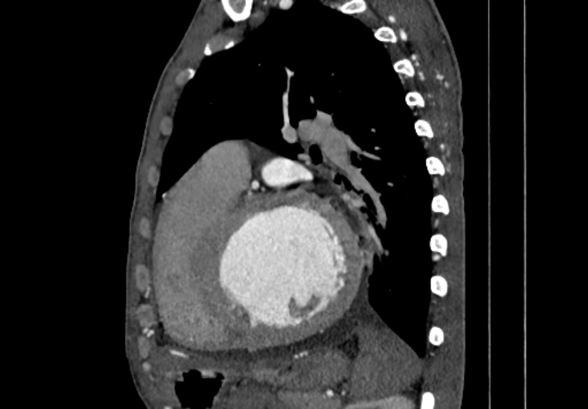Coarctation of aorta with aortic valve stenosis (Radiopaedia 70463-80574 B 123).jpg