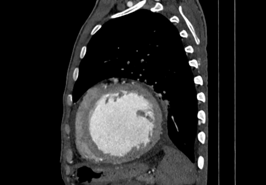Coarctation of aorta with aortic valve stenosis (Radiopaedia 70463-80574 B 155).jpg