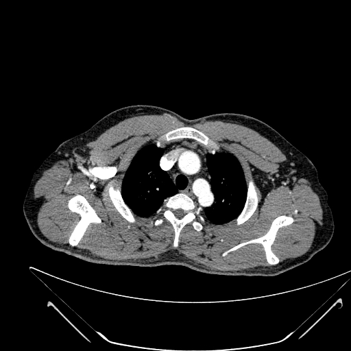 File:Coarctation of the aorta (Radiopaedia 49784-55050 B 28).jpg