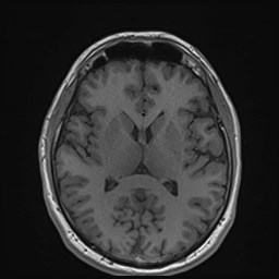 File:Cochlear incomplete partition type III associated with hypothalamic hamartoma (Radiopaedia 88756-105498 Axial T1 109).jpg