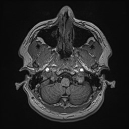 File:Cochlear incomplete partition type III associated with hypothalamic hamartoma (Radiopaedia 88756-105498 Axial T1 39).jpg