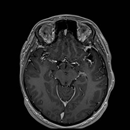 Cochlear incomplete partition type III associated with hypothalamic hamartoma (Radiopaedia 88756-105498 Axial T1 C+ 89).jpg