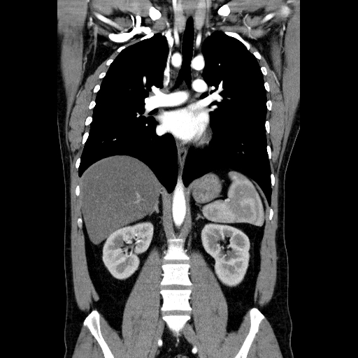 File:Codominant double aortic arch (Radiopaedia 56012-62637 B 27).jpg