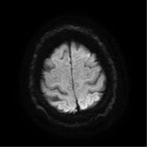 File:Colloid cyst (large) (Radiopaedia 34415-35729 Axial DWI 19).png
