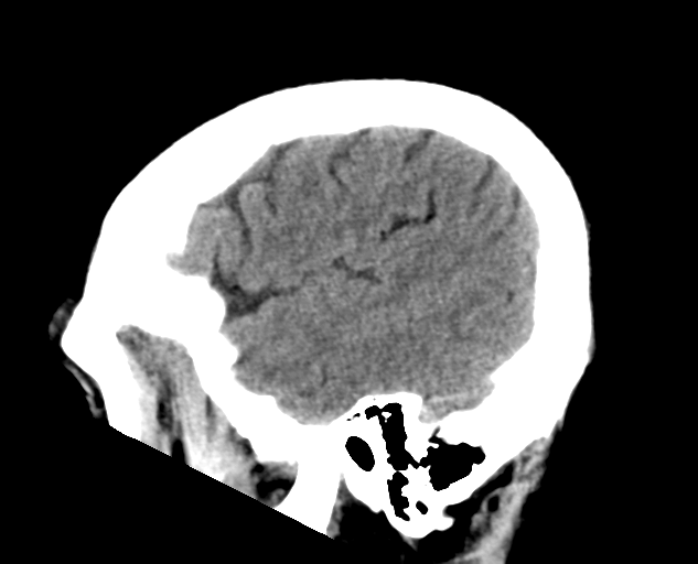 File:Colloid cyst of the third ventricle (Radiopaedia 86571-102661 B 7).png