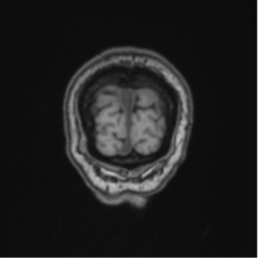 Colloid cyst of the third ventricle (Radiopaedia 86571-102662 Coronal T1 9).png