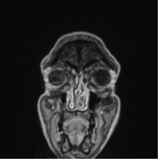 File:Colloid cyst of the third ventricle (Radiopaedia 86571-102662 Coronal T1 C+ 85).png