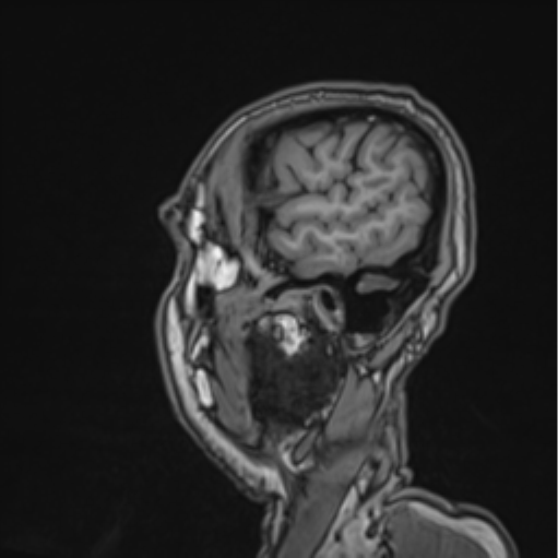 File:Colloid cyst of the third ventricle (Radiopaedia 86571-102662 Sagittal T1 68).png