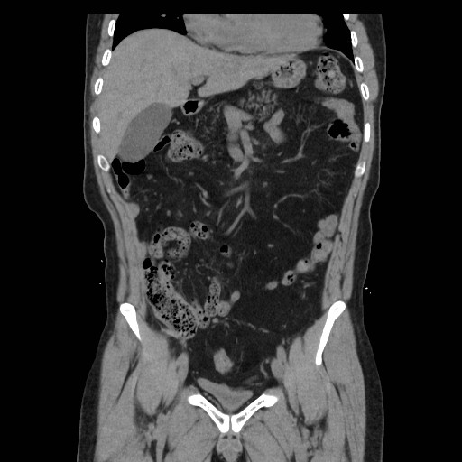 File:Colocutaneous fistula in Crohn's disease (Radiopaedia 29586-30093 Coronal non-contrast 8).jpg