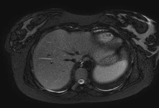 Colon adenocarcinoma with Krukenberg tumors, advanced pregnancy (Radiopaedia 67279-76645 Axial T2 SPAIR 76).jpg