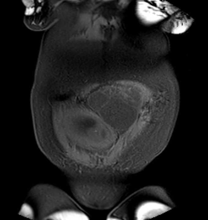Colon adenocarcinoma with Krukenberg tumors, advanced pregnancy (Radiopaedia 67279-76645 E 7).jpg
