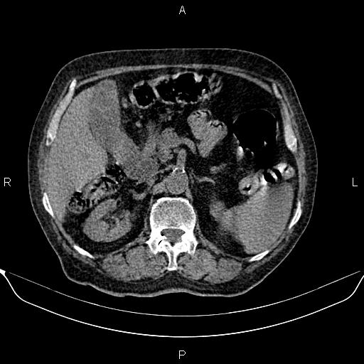 File:Colon cancer (Radiopaedia 90215-107432 Axial non-contrast 31).jpg