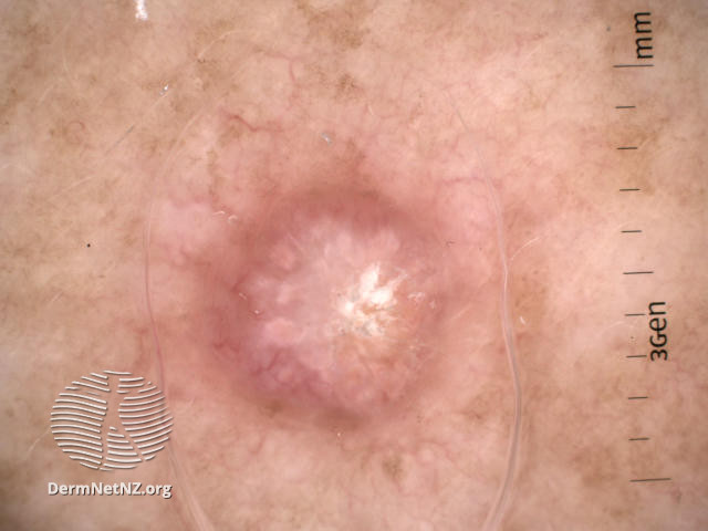 File:Dermoscopy view of histologically confirmed atypical fibroxanthoma (DermNet NZ atypical-fibroxanthoma-dermoscopy-01-v3).jpg