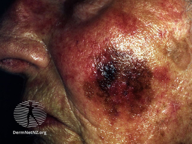 File:Lentigo maligna melanoma (DermNet NZ lesions-mel14).jpg