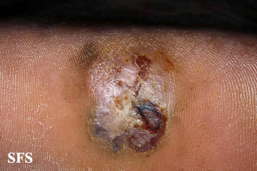 File:Melanoma (Dermatology Atlas 76).jpg