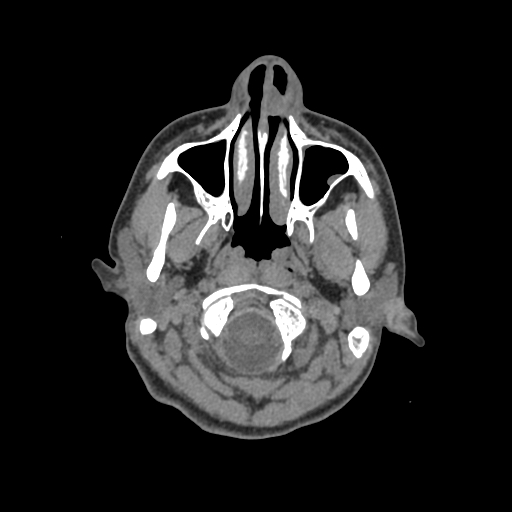Nasal pyogenic granuloma (lobular capillary hemangioma) (Radiopaedia 85536-101244 Axial non-contrast 23).jpg