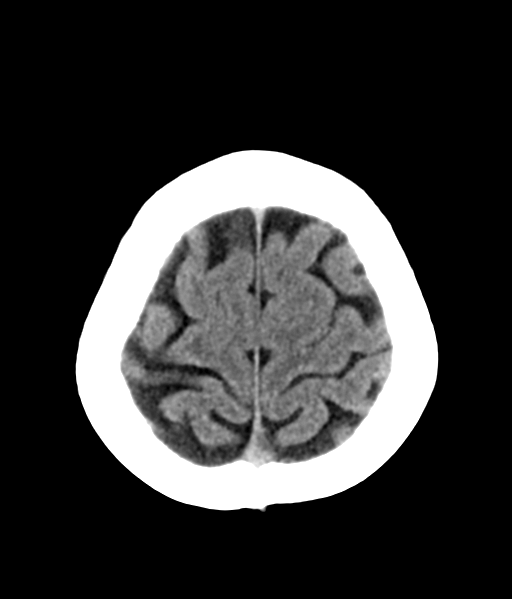File:Nasopharyngeal carcinoma with cerebral abscess (Radiopaedia 43018-46275 Axial non-contrast 45).png