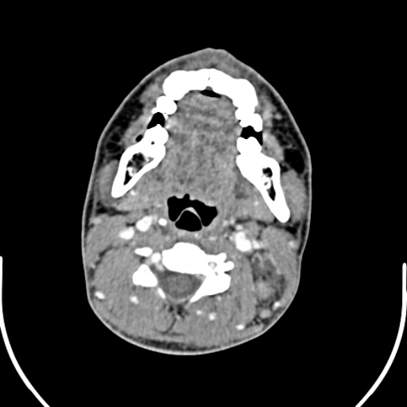 File:Nasopharyngeal carcinoma with skull base invasion (Radiopaedia 53415-59705 A 107).jpg