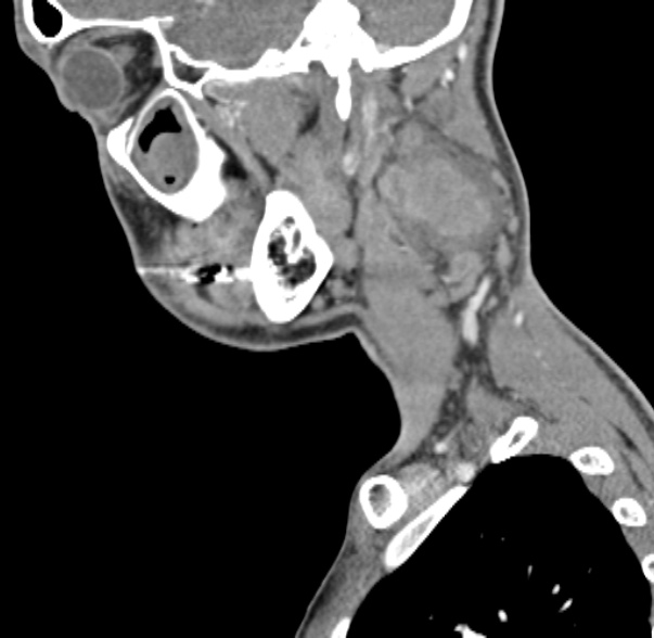 File:Nasopharyngeal carcinoma with skull base invasion (Radiopaedia 53415-59705 C 55).jpg