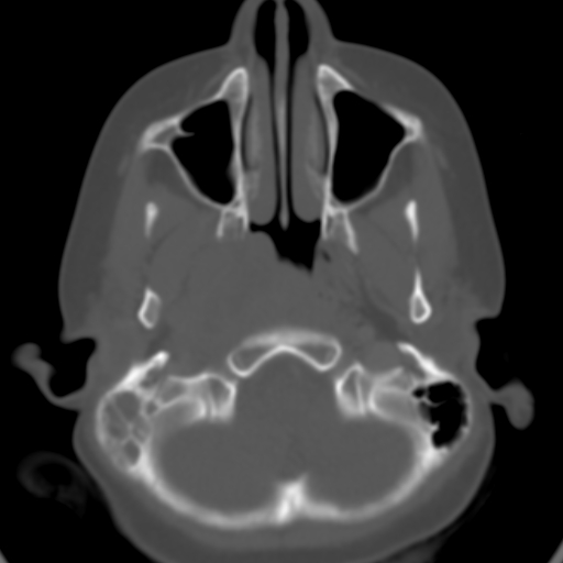 File:Nasopharyngeal rhabdomyosarcoma (Radiopaedia 23417-23491 Axial bone window 6).jpg