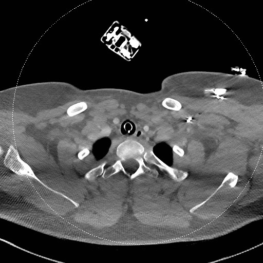Neck CT angiogram (intraosseous vascular access) (Radiopaedia 55481-61945 B 101).jpg