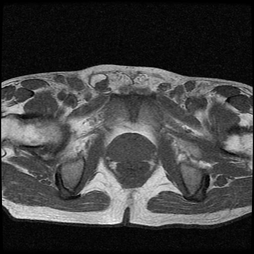 File:Necrotizing epididymo-orchitis with intra-testicular abscess (Radiopaedia 29397-29860 Axial T1 5).jpg