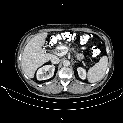 Necrotizing pancreatitis (Radiopaedia 87796-104249 A 19).jpg